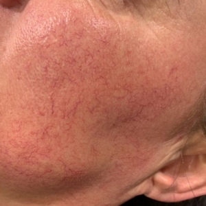 Roodheden/couperose/rosacea