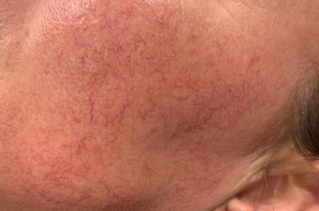 IMG_2775 Rosacea/couperose - MaRo Izegem