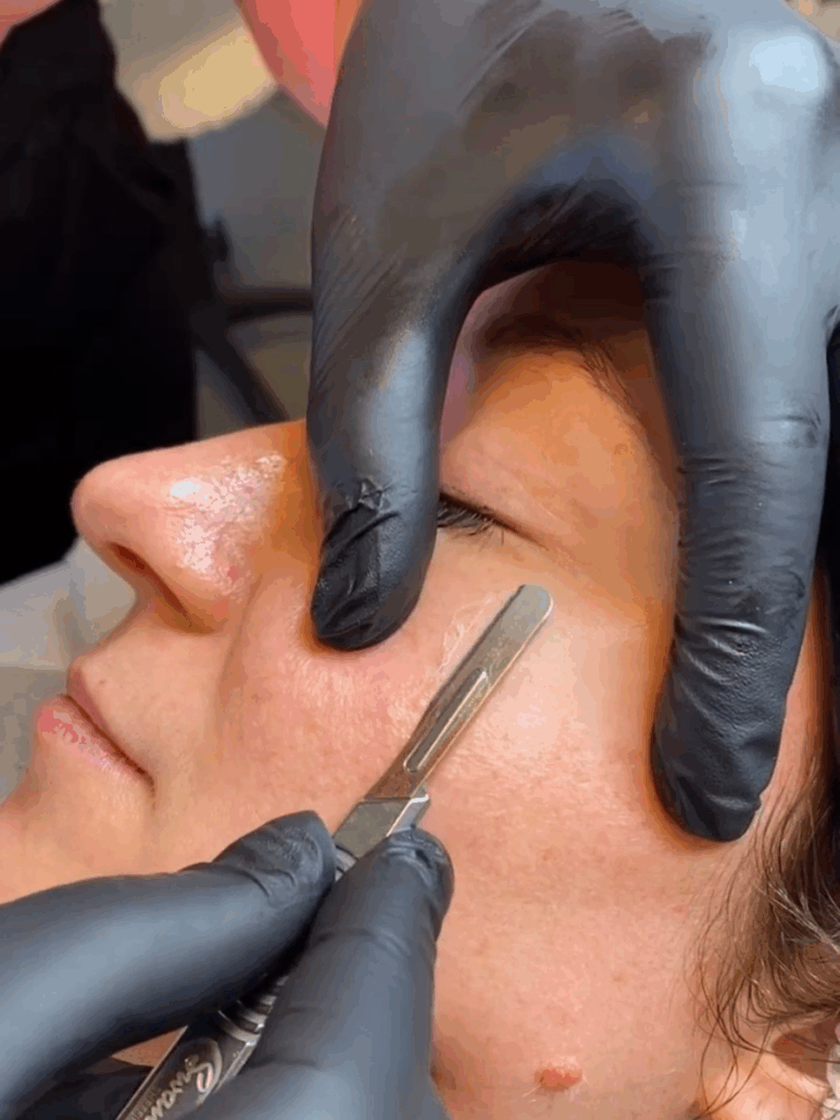 Dermaplaning MaRo Izegem